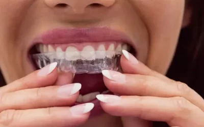 Invisalign St. Petersburg: Clear Aligner Therapy for Discreet Orthodontic Correction